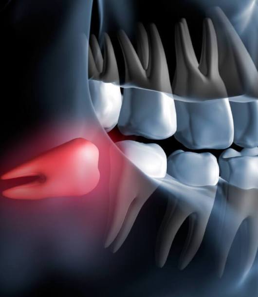 20 yaş gömülü diş çekimi | antakya diş hekimleri