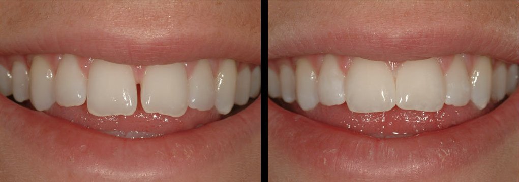 bonding uygulaması estetik dolgu | antakya diş hekimleri