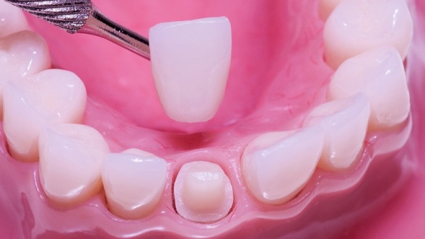 zirkonyum diş kaplama | antakya diş hekimleri